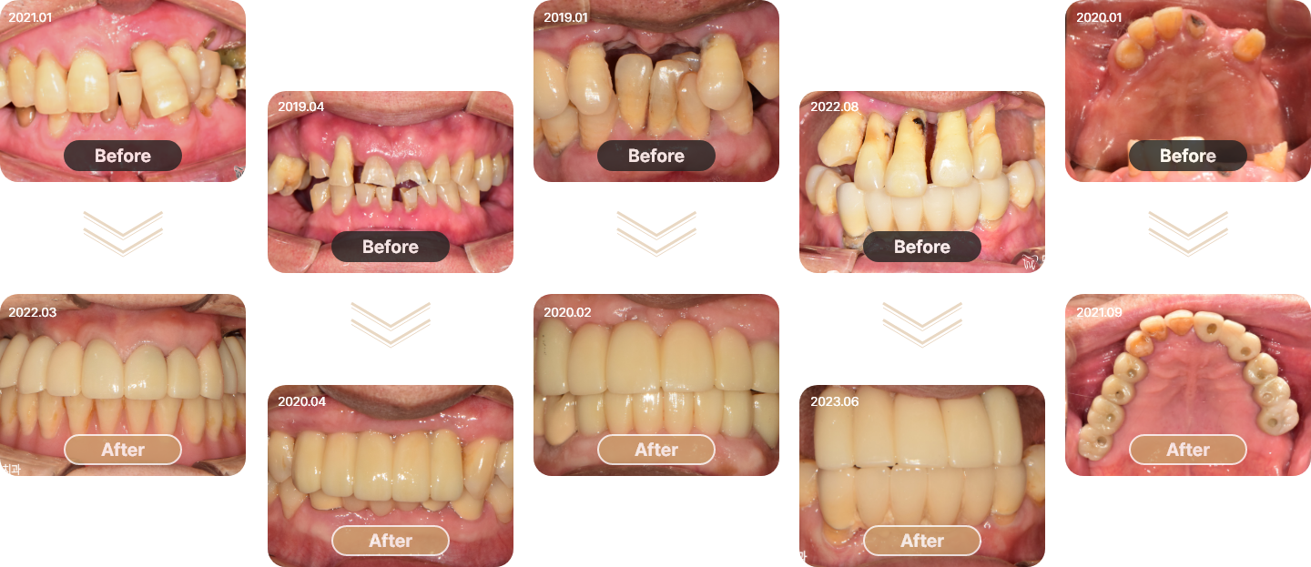 임플란트 케이스
